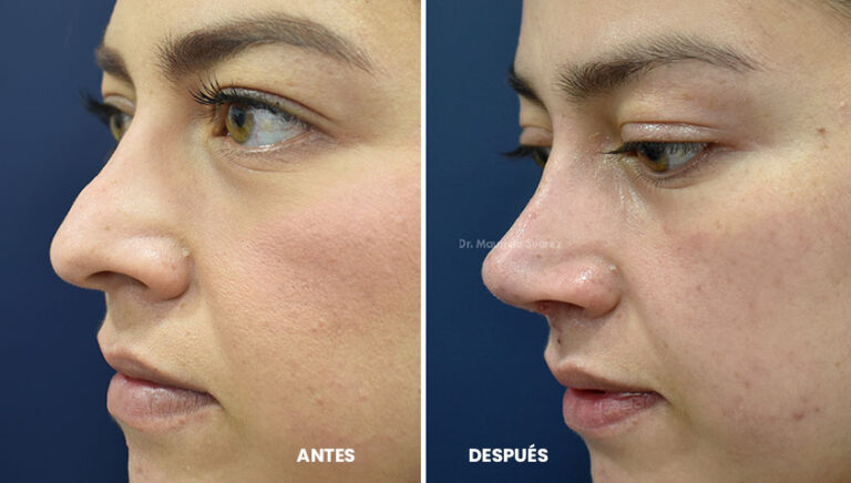 Cómo cambia la nariz después de una rinoplastia