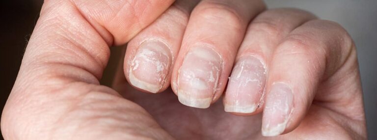 Cómo curar uñas con rayas negras