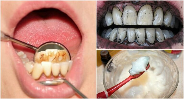 Cómo eliminar el sarro de los dientes de forma casera