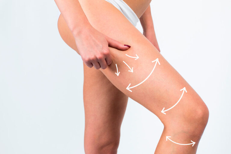 Cómo eliminar la flacidez de las piernas