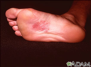 Dermatitis en la planta del pie