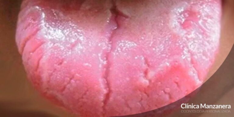 Grietas en la lengua con dolor