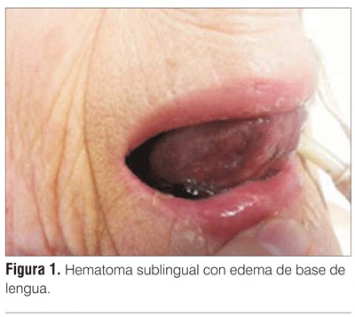 Hematoma en la lengua por mordedura