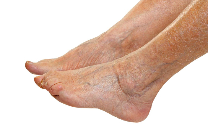 Manchas marrones en las piernas por mala circulación
