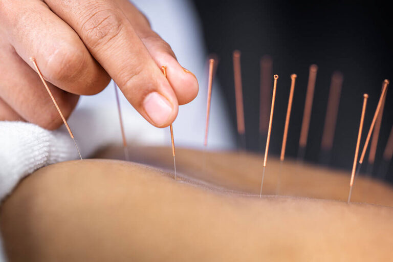 Qué es la acupuntura y sus beneficios