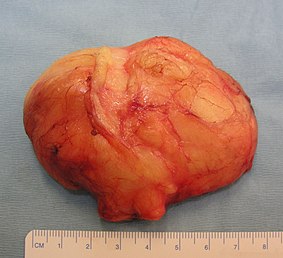 Tumor benigno formado por células de grasa