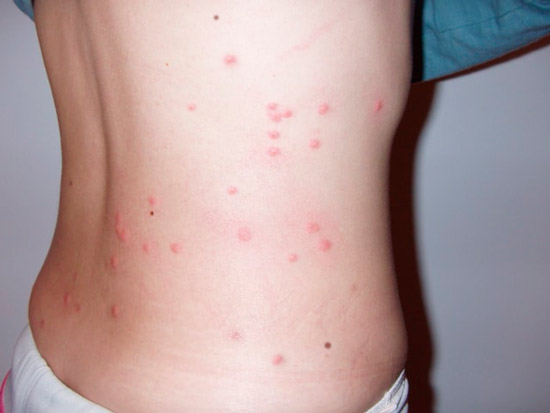 Alergia a las pulgas en humanos