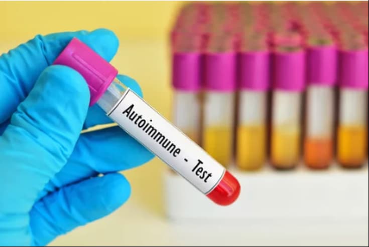 Análisis de sangre para detectar enfermedad autoinmune