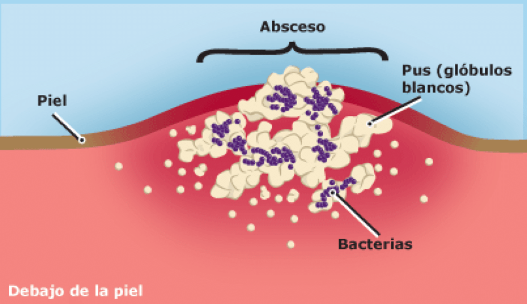 Cuanto tarda en curar un absceso - Normalweb.es