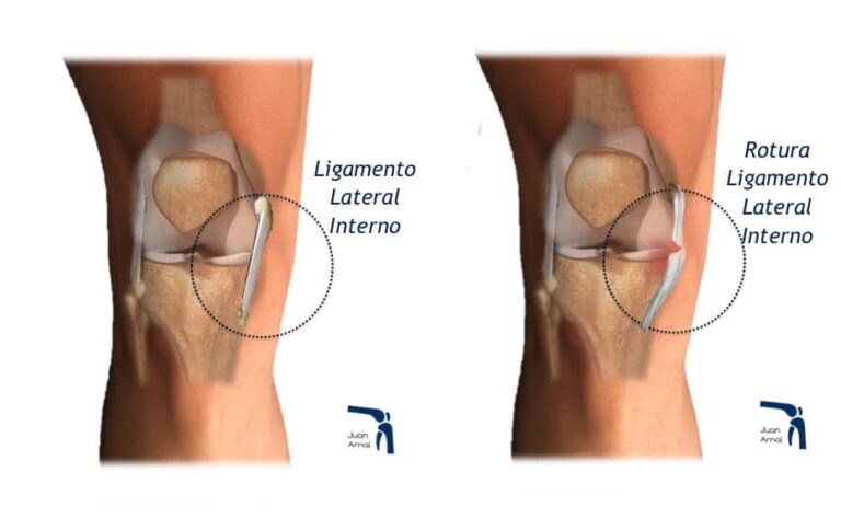 Distensión del ligamento lateral interno de la rodilla