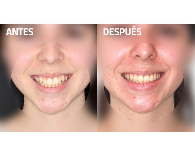 Extraccion de premolares antes y después