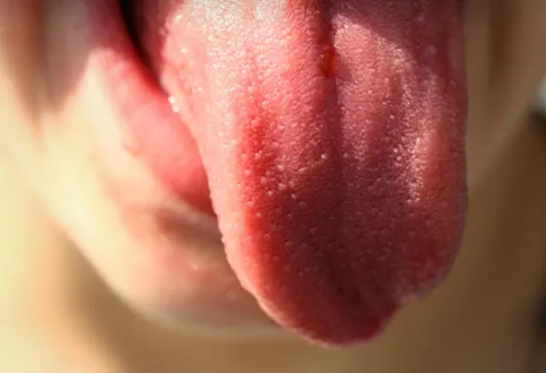 Granos en la lengua y dolor de garganta