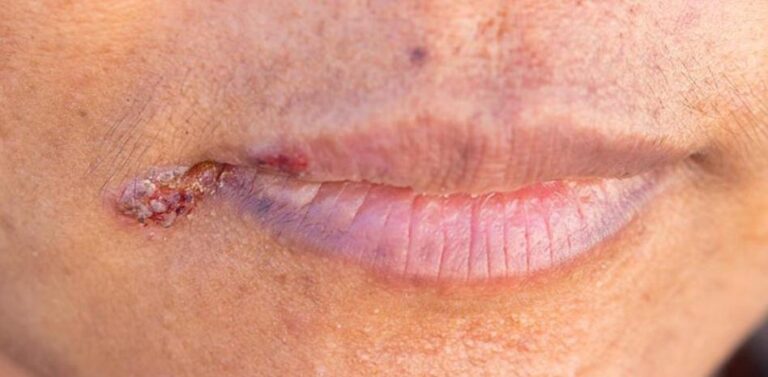 Heridas en las comisuras de los labios