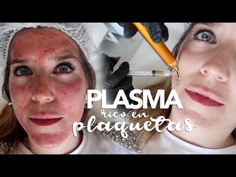 Plasma rico en plaquetas cara hinchada