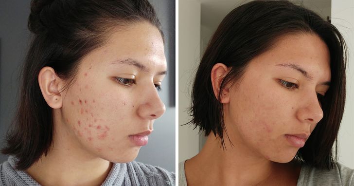 Rosa mosqueta acné antes y después