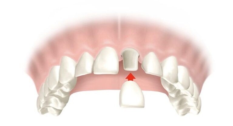 Tipos de coronas para implantes dentales