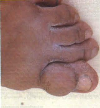 Tumor en el dedo gordo del pie
